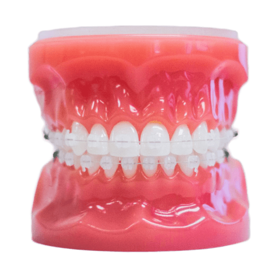 clear braces on plastic model