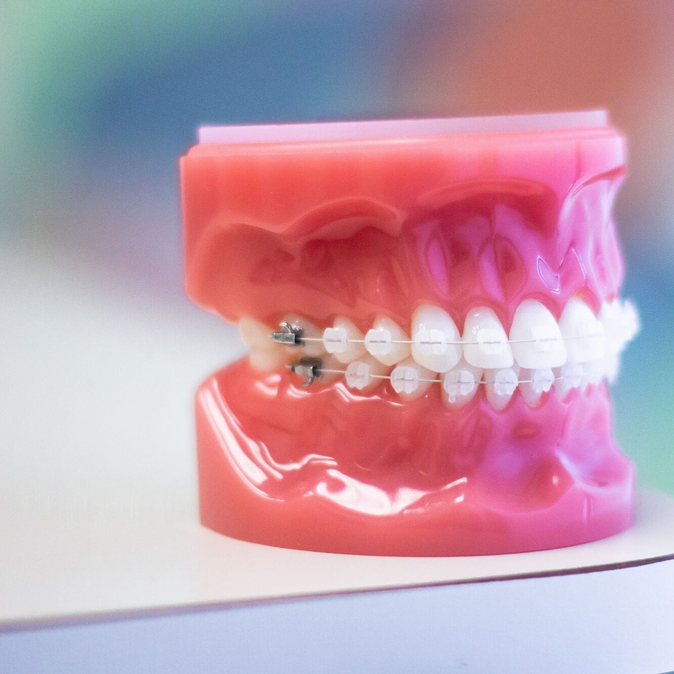 Braces Treatment Options